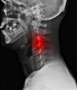 The Life-Altering Effects of a Broken Neck