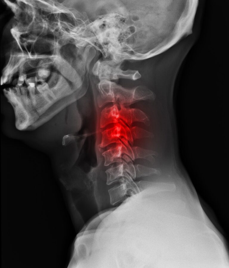 The Life-Altering Effects of a Broken Neck | Berger & Green