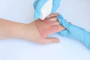 Pittsburgh Burn Injury Lawyer