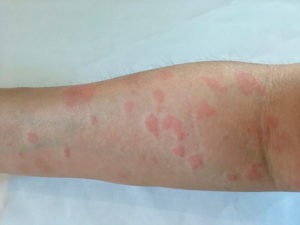 Pittsburgh Lupus Lawyer